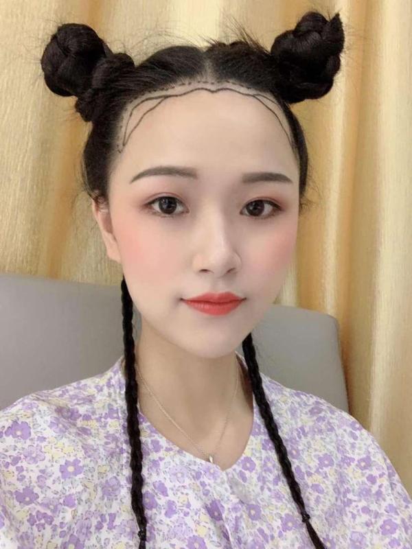 昆明植發案例，哪種發際線好看